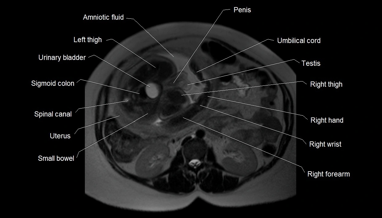 MRI fetal anatomy axial image 6.webp